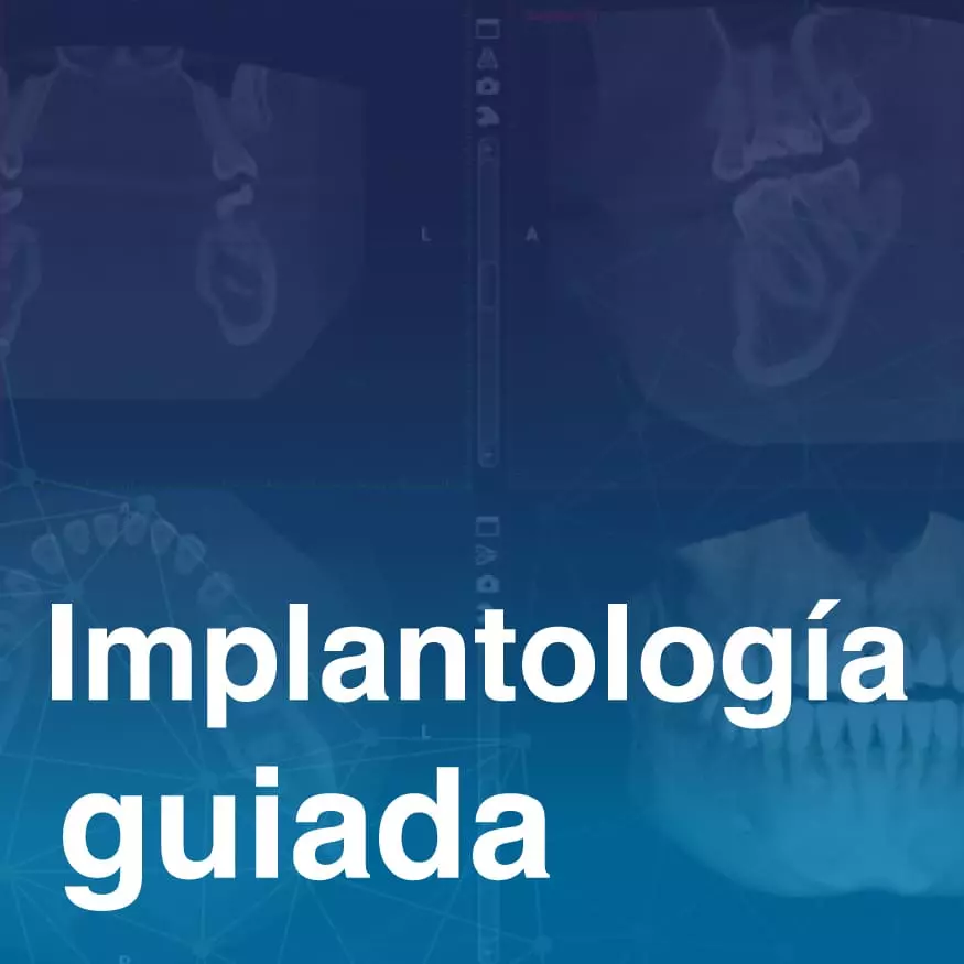 Implantologia_guiada